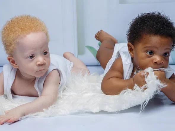 Запознайте се с близнаците, които покориха света заради различния цвят на кожата (Снимки и Видео)